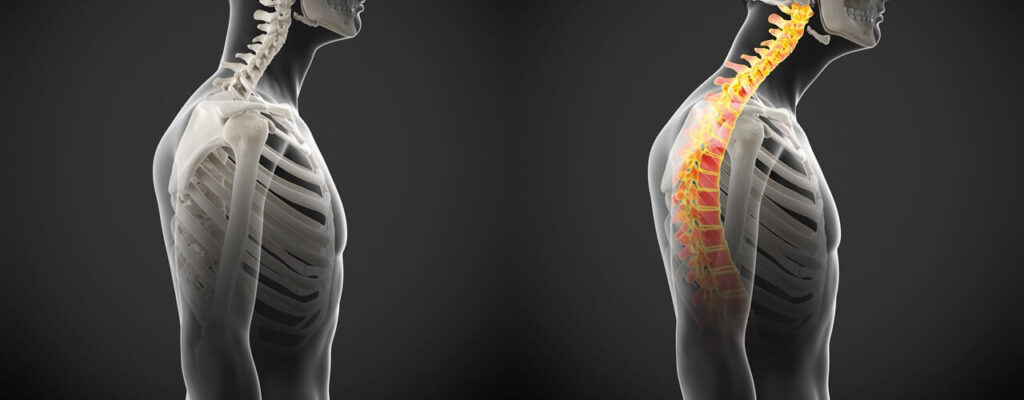 Understanding Postural Dysfunction: Causes, Effects, and Physical Therapy Solutions