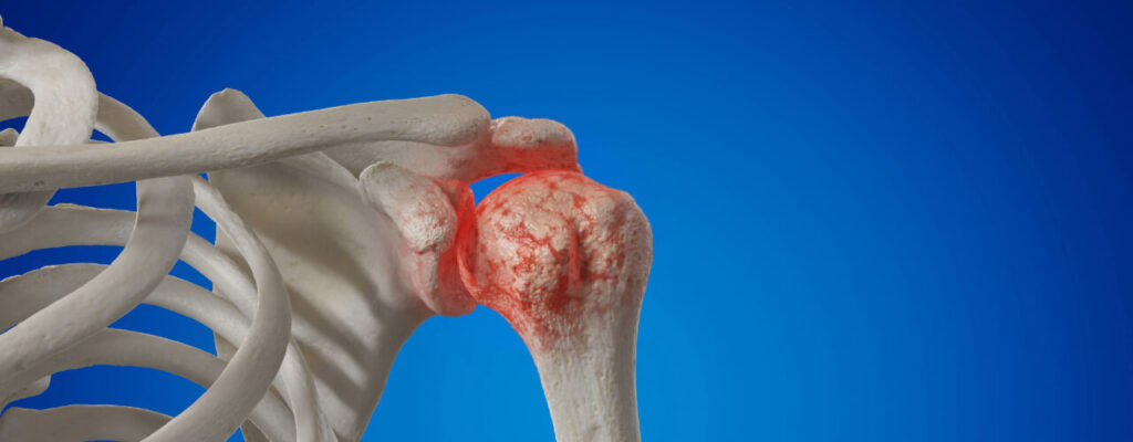 Arthritis in shoulder joint relief in South Ogden, UT